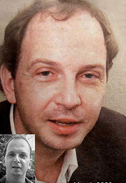 Forehead-brow-lift-surgery--Doctor-Chettawut-face-and-body-contouring-gallery-before-surgery