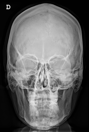 Forehead-type-1-skull-x-ray-AP-view