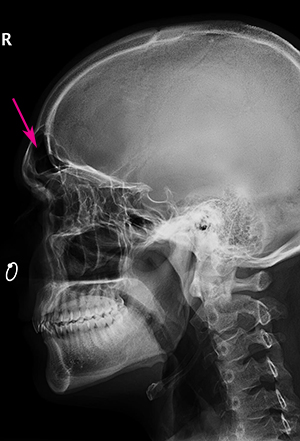 Forehead-type-3-skull-x-ray-Lat-view