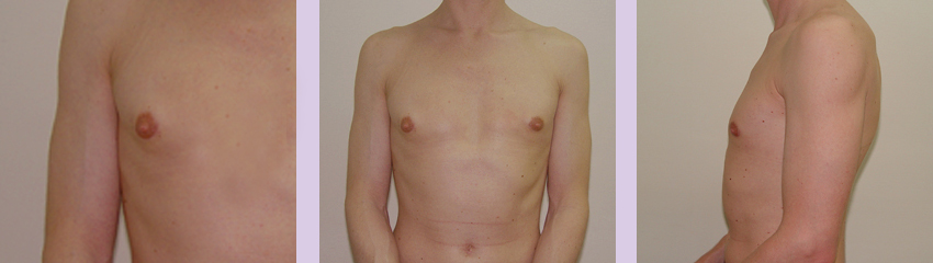 Gynecomastia-surgery-doctor-Chettawut-Gallery--after-total-breast-removal-surgery
