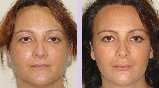 Lip-augmentation-surgery--Doctor-Chettawut-face-and-body-contouring-gallery