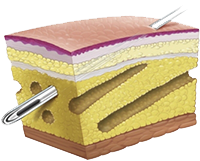 Liposuction-tumescent-with-fine-canula