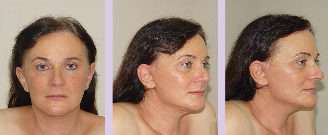 Partial-facial-feminization-surgery-by-doctor-Chettawut-case-2-after-surgery