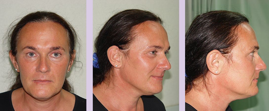 Partial-facial-feminization-surgery-by-doctor-Chettawut-case-2-before-surgery