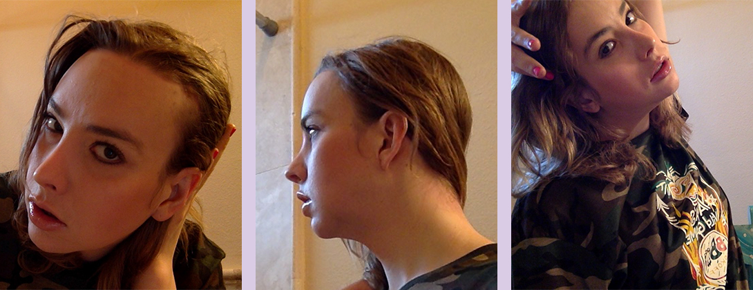 Reduction-rhinoplasty-surgery--Doctor-Chettawut-facial-cosmetic--gallery-after