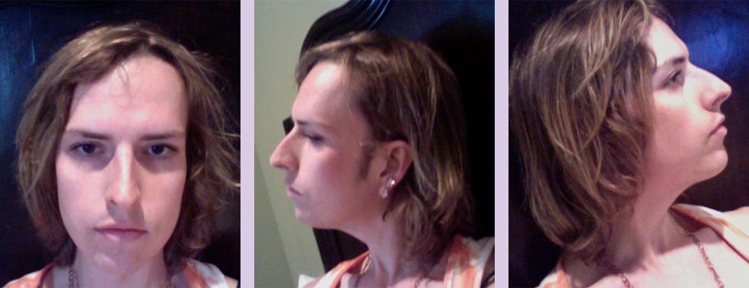 Reduction-rhinoplasty-surgery--Doctor-Chettawut-facial-cosmetic--gallery-before