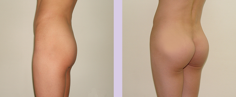 Result-Buttock-implant-surgery-300-cc-Left-by-Chettawut-MD
