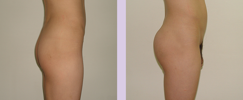 Result-Buttock-implant-surgery-300-cc-Right-by-Chettawut-MD