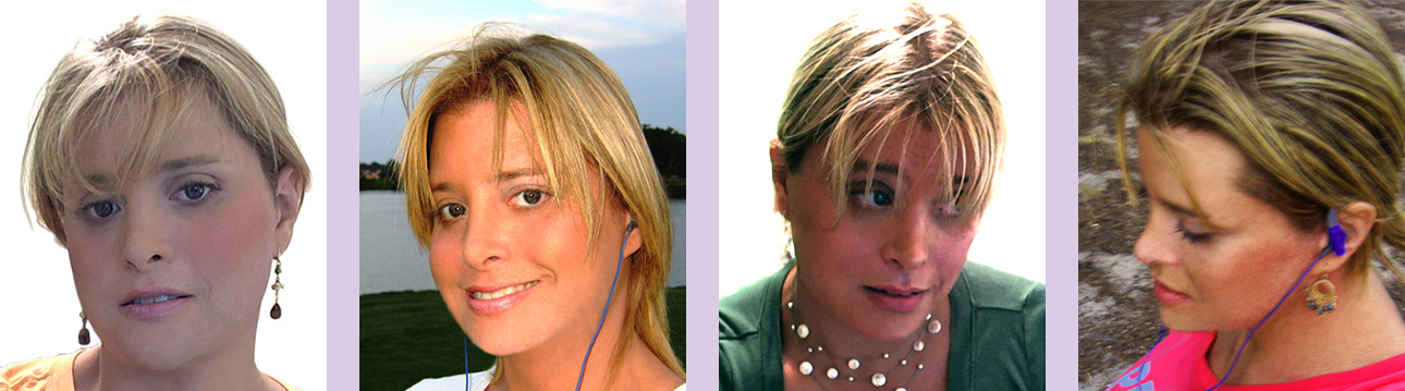 Result-of-Cheek-bone-implant-surgery-by-Chettawut-MD