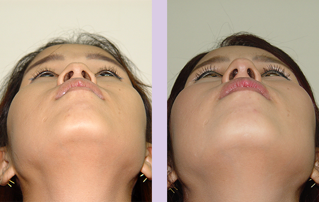 Result-of-alarplasty-by-Chettawut-MD