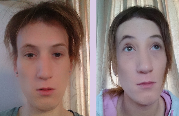 Result-of-forehead-contouring-surgery-by-Chettawut-MD-front