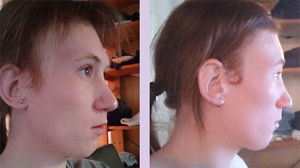Result-of-forehead-contouring-surgery-by-Chettawut-MD-right
