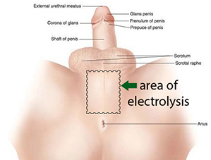 Sex-Reassignment-Surgery-Doctor-Chettawut-recommended-area-for-genital-electrolysis