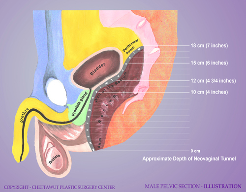 Sex Reassignment Surgery Picture 81