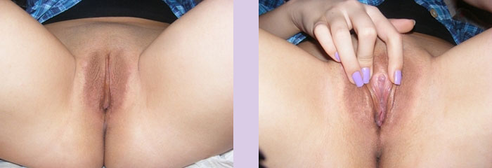 sex-reassignment-surgery-example-result-by-dr-chettawut-bangkok-thailand"
