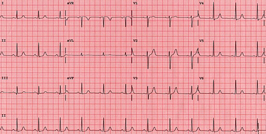 Standard 12 lead EKG requirement from Chettawut Plastic Surgery Center