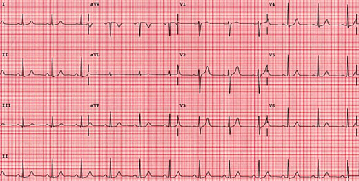 exemple de ekg