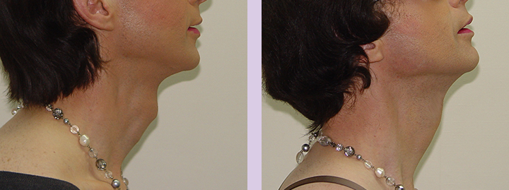Trachea-Shave-Surgery-before-and-after-case-2-by-doctor-Chettawut-Baangkok-Thailand