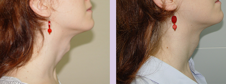 Trachea-Shave-Surgery-before-and-after-case-4-by-doctor-Chettawut-Baangkok-Thailand
