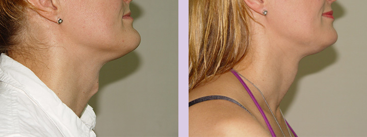 Trachea-Shave-Surgery-before-and-after-case-5-by-doctor-Chettawut-Baangkok-Thailand