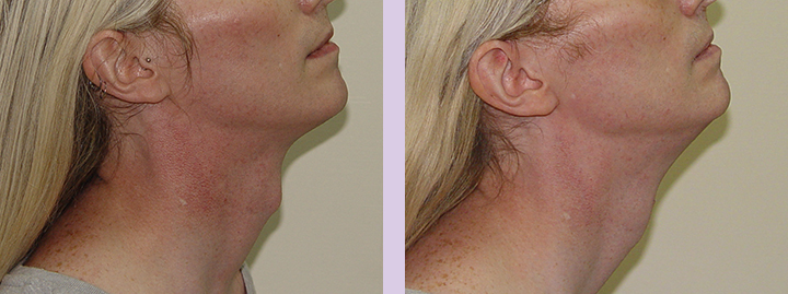 Trachea-Shave-Surgery-before-and-after-case-6-by-doctor-Chettawut-Baangkok-Thailand