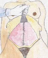 Tummy-tuck-surgical-technique-Doctor-Chettawut
