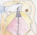 Tummy-tuck-surgical-technique-Dr.Chettawut-Thailand