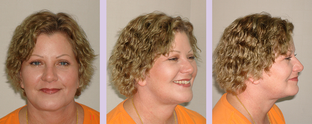 V-line-face-lift-surgery-doctor-Chettawut-facial-cosmetic-surgery-gallery-after