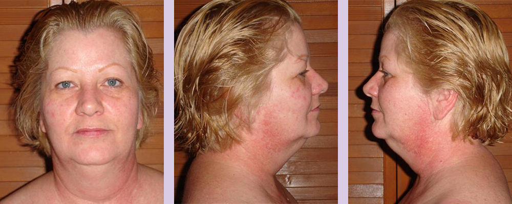 V-line-face-lift-surgery-doctor-Chettawut-facial-cosmetic-surgery-gallery-before
