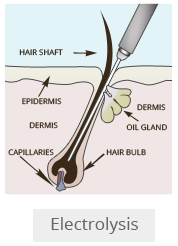 electrolysis for sex reassignment surgery