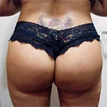 After-Buttock-implant-surgery-330-cc-thumbnail