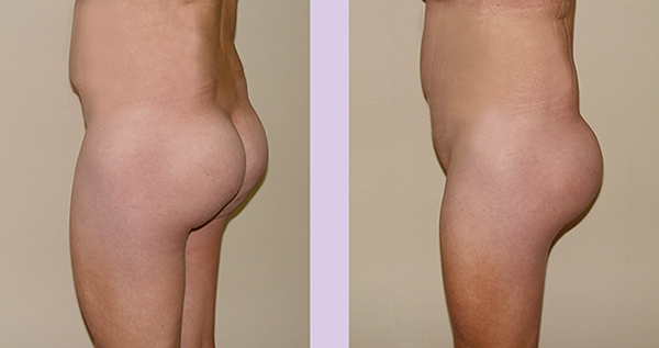 After-Buttock-implant-surgery-360-cc-by-doctor-Chettawut
