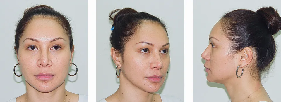 Jaw and Chin reduction surgery 29 years old patient from France After 4 years