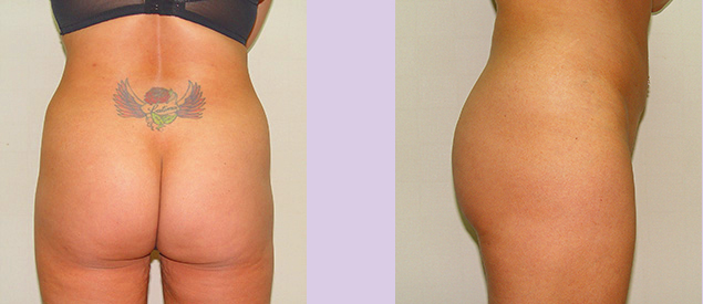Before-Buttock-implant-surgery-330-cc--by-doctor-Chettawut