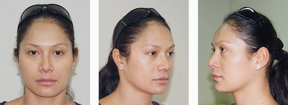 Jaw and Chin reduction surgery 29 years old patient from France Before Jaw and Chin contouring surgery
