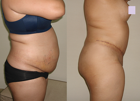 Before-and-after-abdominoplasty-by-Chettawut-MD