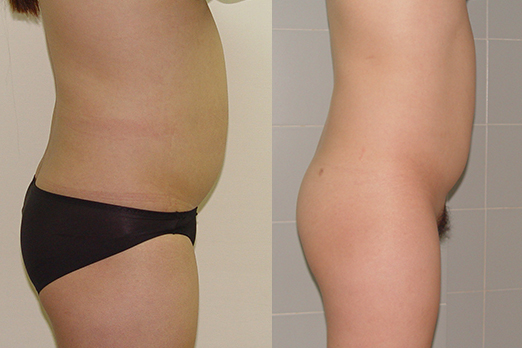 Before-and-after-liposuction-by-Chettawut-MD