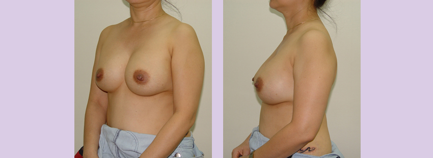 Breast-implant-surgery-435cc--Doctor-Chettawut-breast-augmnetation-gallery-after-surgery