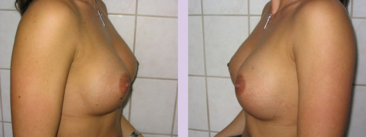 Breast-implant-surgery-470cc--Doctor-Chettawut-breast-augmnetation-gallery-after-surgery