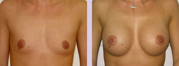 Breast-implant-surgery-470cc--Doctor-Chettawut-breast-augmnetation-gallery-before-and-after-surgery