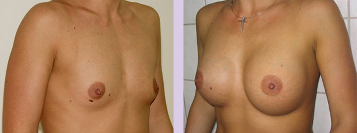 Breast-implant-surgery-470cc--Doctor-Chettawut-breast-augmnetation-gallery-before-and-after1-surgery