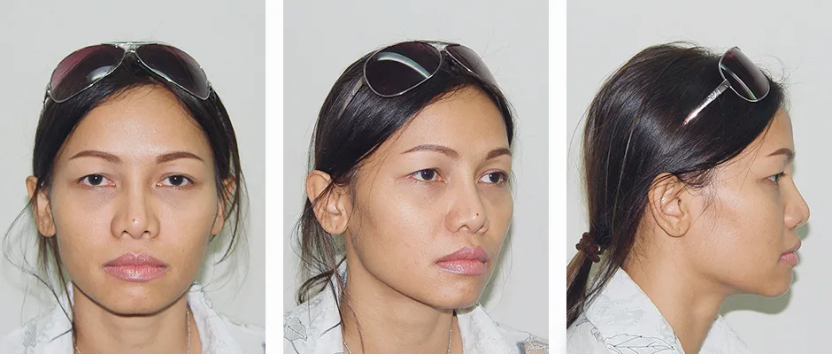 Asian Nose Augmentation Surgery and Alarplasty 35 years old patient from Thailand After 2 years