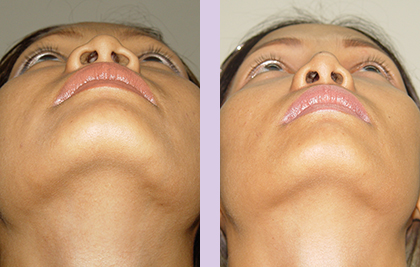 Cosmetic-facial-implant-surgery-by-doctor-Chettawut-Gallery-Case-2-before-and-after-nose-implant-and-alarplasty-surgery