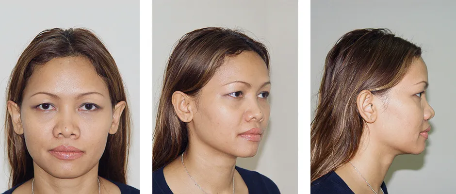 Asian Nose Augmentation Surgery and Alarplasty 35 years old patient from Thailand Before
