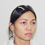 Case 4 Augmentation Rhinoplasty + Alarplasty