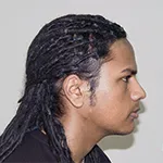 Case 4 Chin Augmentation with chin implant surgery