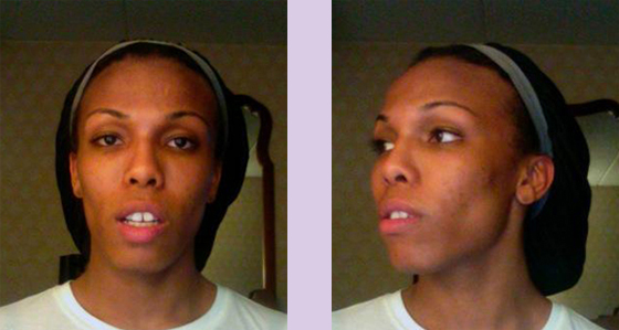 Doctor-Chettawut-full-facial-feminization-work-jaw-contouring-before-surgery