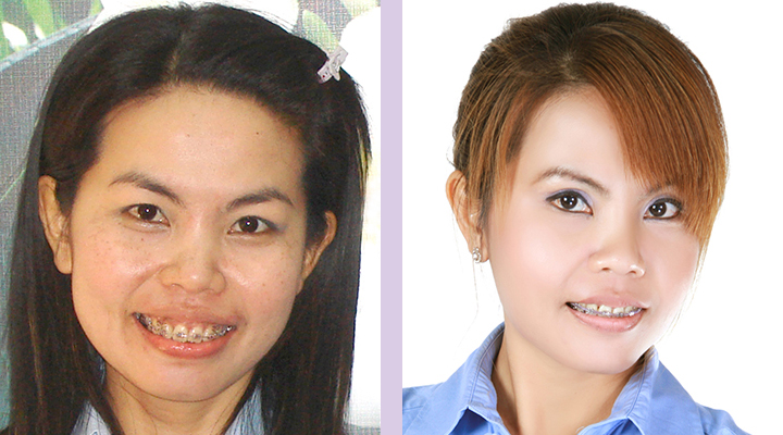 Double-eyelid-surgery-for-Asian--Doctor-Chettawut-facial-cosmetic-surgery-gallery-case-2