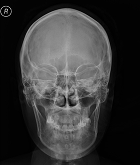 Example-of-skull-x-ray--front-view-