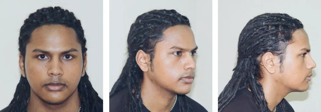 Facial-chin-implant-surgery-by-doctor-Chettawut-after